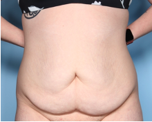Body Lift Before & After Patient #34335